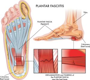 illustration of plantar fasciitis, foot health awareness month