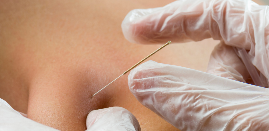 dry needling
